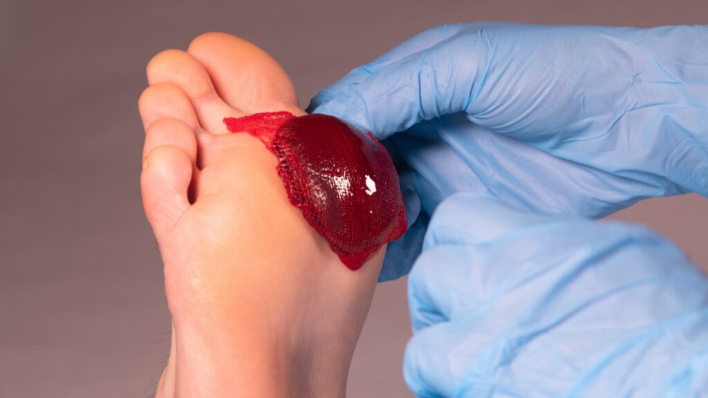 A revolutionary blood clot that can heal chronic wounds newsi.co.za